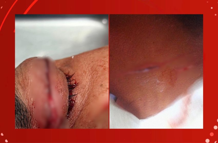  Linha com cerol deixa motociclistas gravemente feridos nos olhos e pescoço em Oiapoque, no AP
